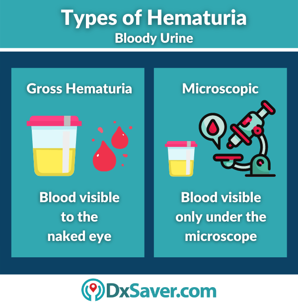 Hematuria Blood In Urine 2 