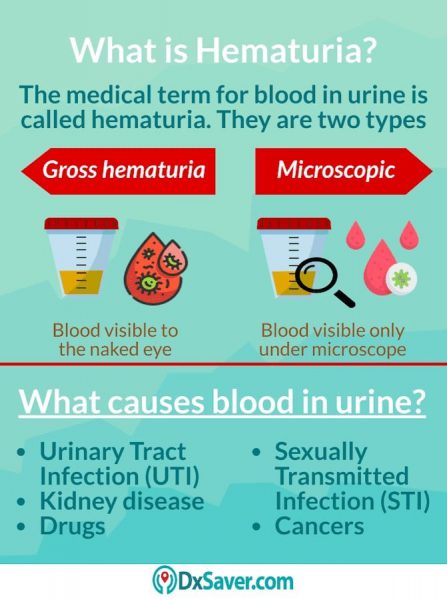 Why Do I See Blood in the Urine? Types of STDs Causing Blood in Urine